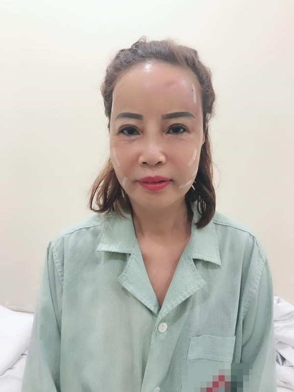 Dien mao moi gay bat ngo cua co dau 61 sau phau thuat-Hinh-2