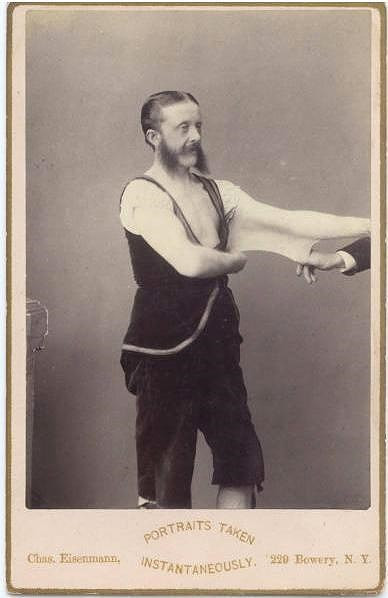 Felix Wehrle, được gọi là người "Đàn ông cao su". Bức hình chụp vào khoảng năm 1900. Felix mắc hội chứng Ehlers-Danlos cho phép kéo giãn làn da.