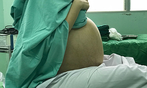 Bụng to bất thường của cô gái 20 tuổi.