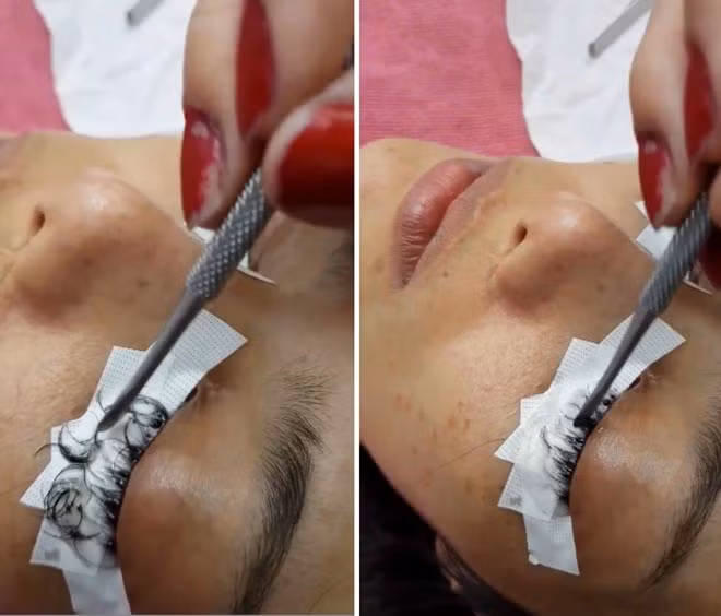 Ham re, co gai Thai Lan suyt hong mat vi noi mi bang keo dan sat-Hinh-2