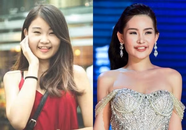 Hình ảnh trước - sau của Lê Âu Ngân Anh cho thấy sự thay đổi lớn về răng.