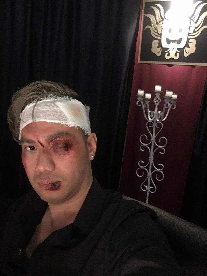 Một số hình ảnh phía sau ống kính cho thấy, nam diễn viên có cảnh đánh nhau tới bầm dập mặt mũi.