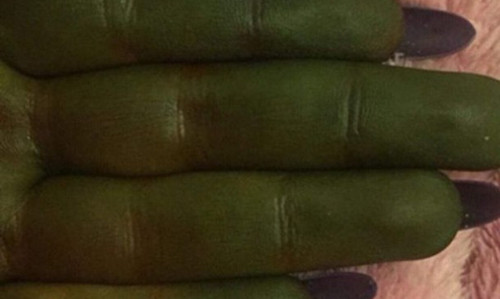 Bàn tay xanh lè của Danni sau khi nhuộm da.