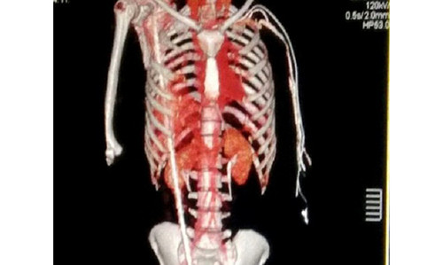 Thanh sắt dài 1,3m đâm xuyên dọc từ háng lên cổ.