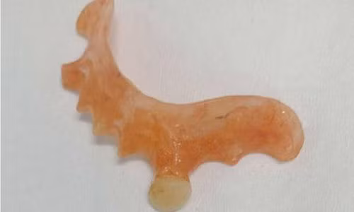 Miếng răng giả được lấy ra khỏi dạ dày bà P.T.D.