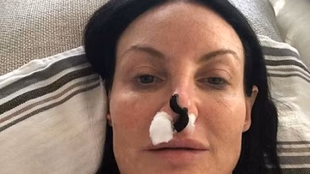 Bà mẹ 40 tuổi đã nhờ đỉa cứu mũi của mình. Ảnh: The Sun