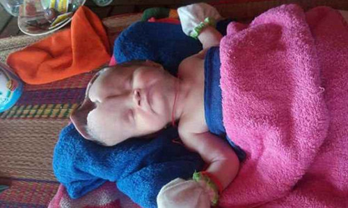 Cô bé Ah Neath, 2 tháng tuổi, sinh ra với phần hộp sọ méo mó, không hoàn chỉnh. Ảnh: Viral Press