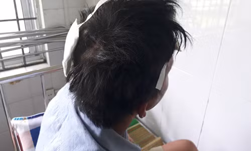 Anh A. với vết thương trên đầu.