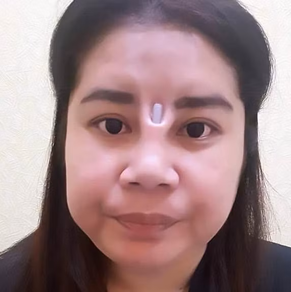 Miếng silicone lồi ra ngoài mũi của người phụ nữ sau thẩm mỹ. Ảnh: Daily Mail. Miếng silicone lồi ra ngoài mũi của người phụ nữ sau thẩm mỹ. Ảnh: Daily Mail.