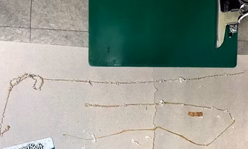 Con sán dây dài 1,67 m ký sinh trong người đàn ông thích ăn sushi. Ảnh: Kenny Banh. Con sán dây dài 1,67 m ký sinh trong người đàn ông thích ăn sushi. Ảnh: Kenny Banh.