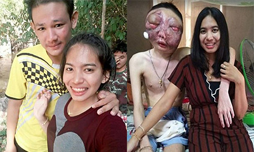 Anh Pooh Chokchai trước và sau khi bị ung thư.