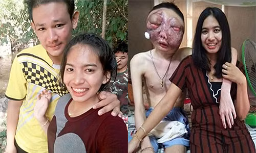 Anh Pooh Chokchai trước và sau khi bị ung thư.