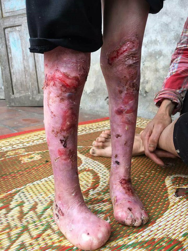 Toàn thân cháu Khánh bị lở loét, rỉ máu, ngón chân bị dính liền "ăn" mất đốt.