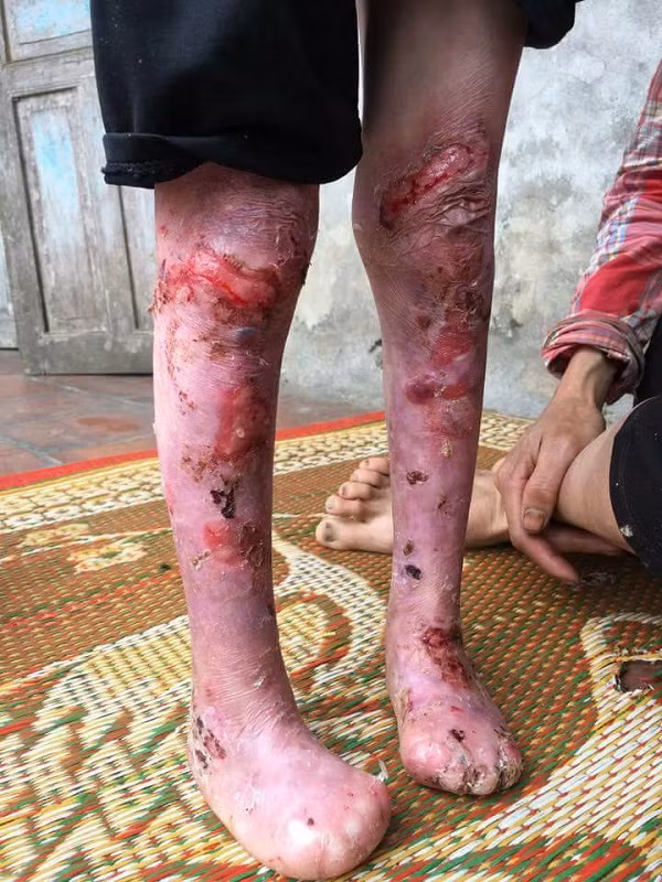 Toàn thân cháu Khánh bị lở loét, rỉ máu, ngón chân bị dính liền "ăn" mất đốt.