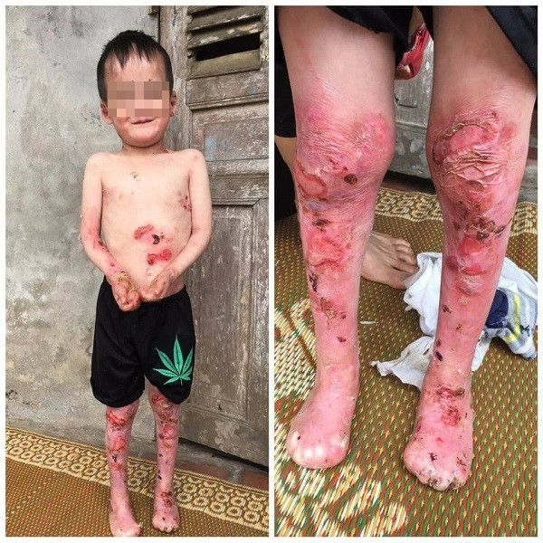 Cháu Nguyễn Tiến Khánh bị bệnh Ly thượng bì bóng nước bẩm sinh.