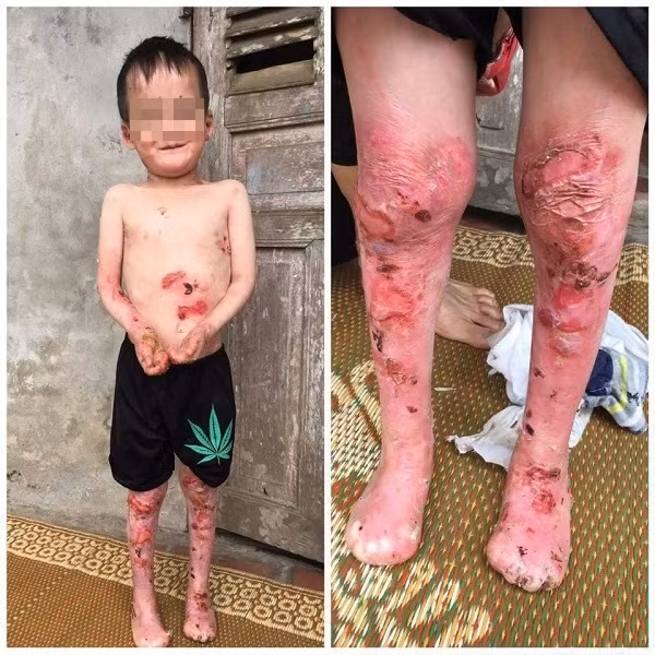 Cháu Nguyễn Tiến Khánh bị bệnh Ly thượng bì bóng nước bẩm sinh.