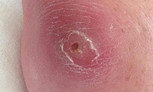 Vết xước nhỏ trên khuỷu tay đã khiến cô Gardner phải đối mặt với cái chết. Ảnh: Daily Mail