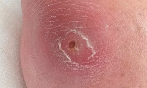 Vết xước nhỏ trên khuỷu tay đã khiến cô Gardner phải đối mặt với cái chết. Ảnh: Daily Mail