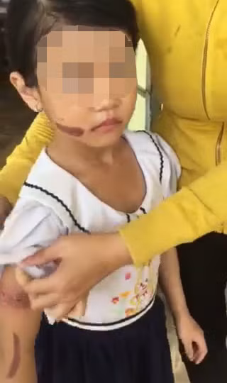 Vết thương ở tay và mặt cháu T.