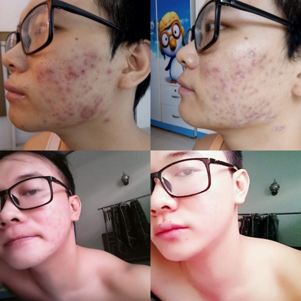 “Trong một lần khám, mình được bác sĩ chia sẻ rằng do tạng người nóng, chỉ nên sử dụng các loại thuốc, hay các phương pháp từ thiên nhiên như ăn nhiều trái cây, đắp mặt nạ hoa quả: đu đủ, dứa… nhằm cải thiện làn da. Những loại quả này hòa toàn lành tính và không gây độc”, anh chia sẻ.