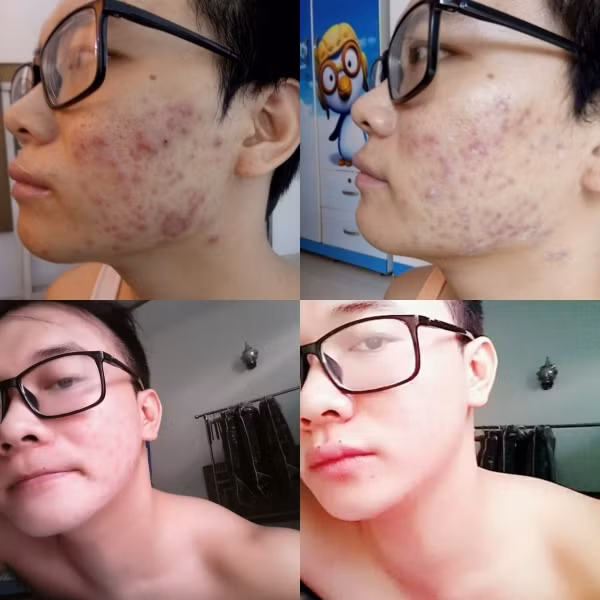 “Trong một lần khám, mình được bác sĩ chia sẻ rằng do tạng người nóng, chỉ nên sử dụng các loại thuốc, hay các phương pháp từ thiên nhiên như ăn nhiều trái cây, đắp mặt nạ hoa quả: đu đủ, dứa… nhằm cải thiện làn da. Những loại quả này hòa toàn lành tính và không gây độc”, anh chia sẻ.