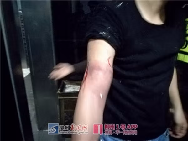 Cánh tay người đàn ông bị chảy máu sau hành động trên.