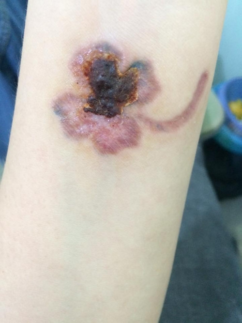 Hình ảnh vết thương bị nhiễm trùng.