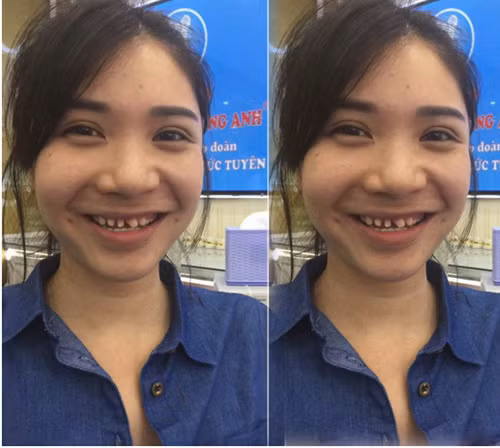 Thanh Bi khẳng định chỉ sửa răng, còn các bộ phận khác đều đẹp tự nhiên - Ảnh: Internet