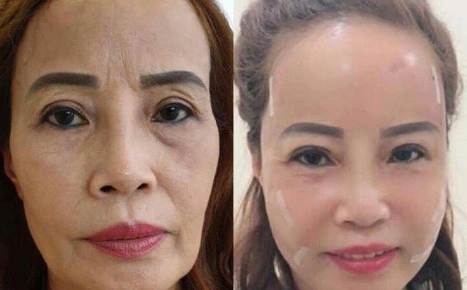 Chu re 26 lay vo 62 tuoi chia se ve vo chong phau thuat tham my-Hinh-3