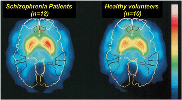 Não của bệnh nhân tâm thần phân liệt (trái) so với não người khỏe mạnh.