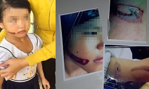 Vết thương ở tay và mặt cháu T.