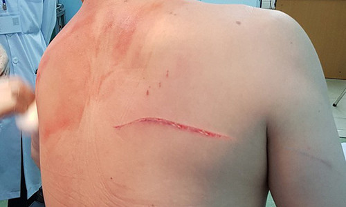 Vết chém trên lưng và vai ông Chiêm Quốc Thái.