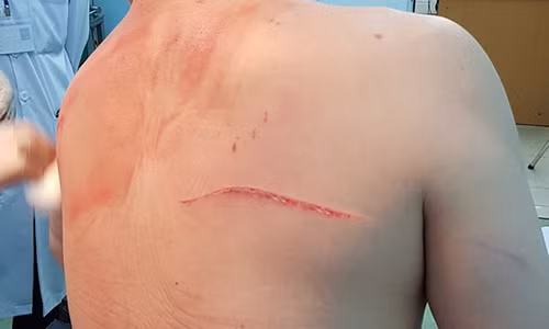 Vết chém trên lưng và vai ông Chiêm Quốc Thái.