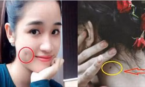 Van menh nguoi co ma lum dong tien, not ruoi truoc nguc hoac sau gay