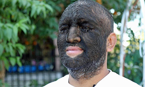 Larry Gomez, sống tại bang California nước Mỹ, được đặt biệt danh là người sói vì 98% cơ thể anh, bao gồm cả mặt, bị che phủ bởi lớp lông đen dày.