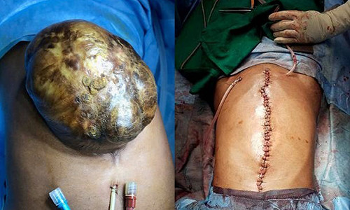 Túi nội tạng bên ngoài cơ thể của cô gái 19 tuổi. Ảnh: SWNS