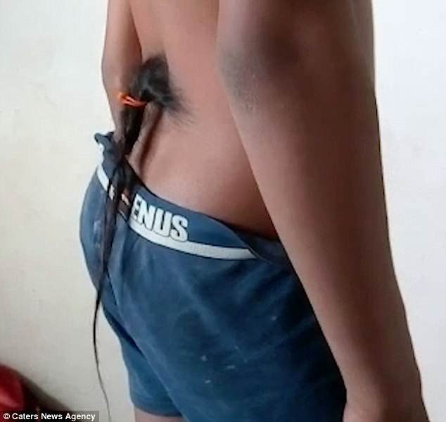 Cậu bé Sohail Shah có búi tóc dài mọc ra từ lưng.