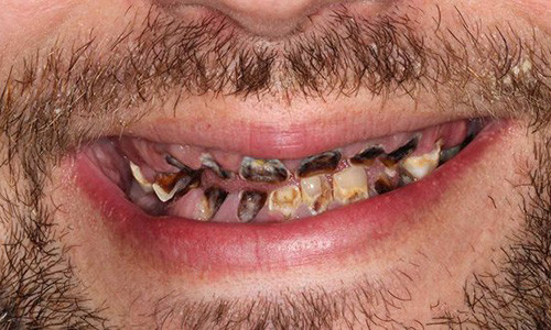 Hàm răng sâu đen, thối rữa và bốc mùi khiến chàng trai trẻ ngại tiếp xúc với mọi người.