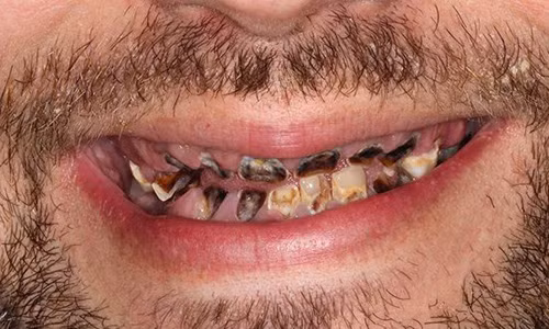 Hàm răng sâu đen, thối rữa và bốc mùi khiến chàng trai trẻ ngại tiếp xúc với mọi người. Hàm răng sâu đen, thối rữa và bốc mùi khiến chàng trai trẻ ngại tiếp xúc với mọi người.