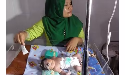 Bố mẹ sốc khi thấy con chào đời chỉ có một mắt giữa trán Bo me soc khi thay con chao doi chi co mot mat giua tran