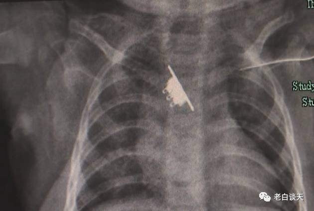 Để con tự chơi, bé gái khóc thét, nôn ra máu, kết quả X-quang khiến cả nhà suy sụp.