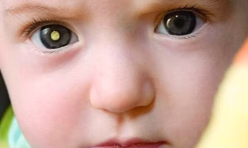 "Thủ phạm" cướp đi ánh sáng của trẻ thơ Ảnh minh họa.