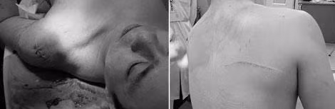 Ông Thái bị chém vào phần lưng và vai với thương tích 5%.