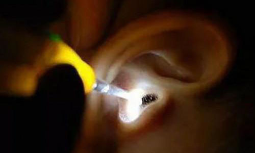 Côn trùng chui vào tai là một tai nạn nguy hiểm, cần sự giúp đỡ của bác sĩ nhanh chóng - Ảnh: SCMP