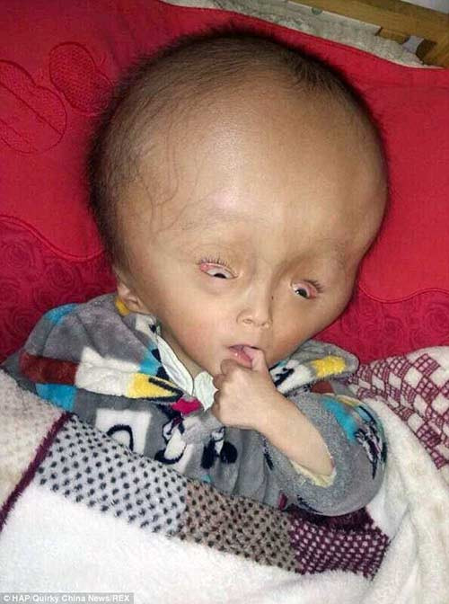 Bên cạnh những đặc điểm chính là thay đổi kích cỡ của vòng đầu thì còn nhiều dấu hiệu khác để xác định. Những trẻ mắc căn bệnh này có biểu hiện khác với những trẻ bình thường như hay giật mình dù chỉ nghe một tiếng động rất nhỏ.