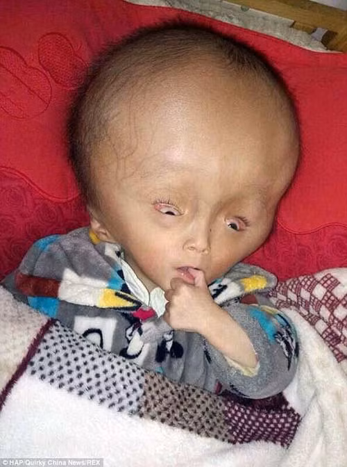 Bên cạnh những đặc điểm chính là thay đổi kích cỡ của vòng đầu thì còn nhiều dấu hiệu khác để xác định. Những trẻ mắc căn bệnh này có biểu hiện khác với những trẻ bình thường như hay giật mình dù chỉ nghe một tiếng động rất nhỏ.