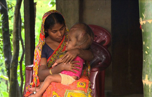 Trẻ sơ sinh mắc bệnh cũng có dấu hiệu khác như khó bú, hay bị sặc sữa và nôn vọt. Trẻ còn khó ngủ, hay khóc, đầu thường ghẹo sang một bên khi nằm. Ở trẻ lớn hơn, các triệu chứng dễ thấy là trẻ hay mệt mỏi, kích thích, khó chịu và nhức đầu.