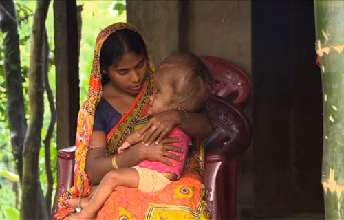 Trẻ sơ sinh mắc bệnh cũng có dấu hiệu khác như khó bú, hay bị sặc sữa và nôn vọt. Trẻ còn khó ngủ, hay khóc, đầu thường ghẹo sang một bên khi nằm. Ở trẻ lớn hơn, các triệu chứng dễ thấy là trẻ hay mệt mỏi, kích thích, khó chịu và nhức đầu.