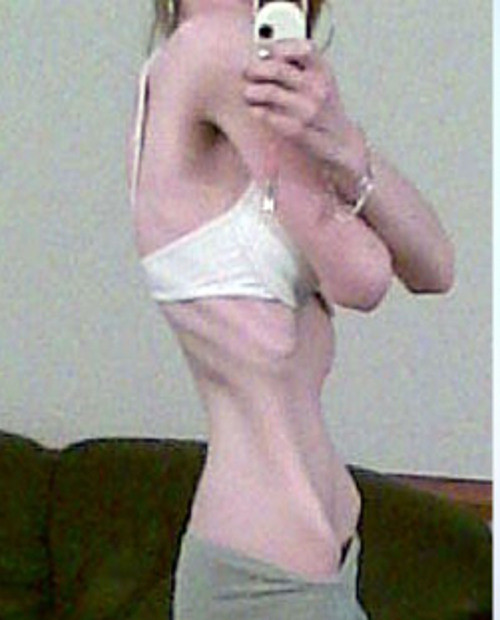 Năm 17 tuổi, cân nặng của Megan tụt giảm nghiêm trọng, chỉ còn vỏn vẹn 27 kg, tương đương với cân nặng trung bình của đứa trẻ 6 tuổi.