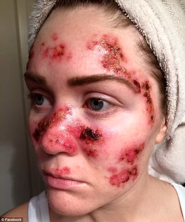 Tawny cũng phải dùng một loại kem chuyên trị và một chuỗi phương pháp điều trị, trong đó có cả việc sử dụng nitơ lỏng trên mặt để đóng băng khối u ung thư.